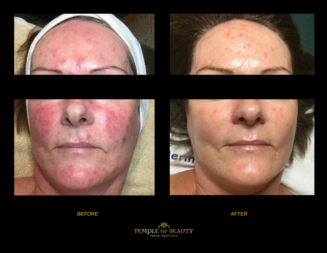 Client Before and After | Skin Rejuvenation