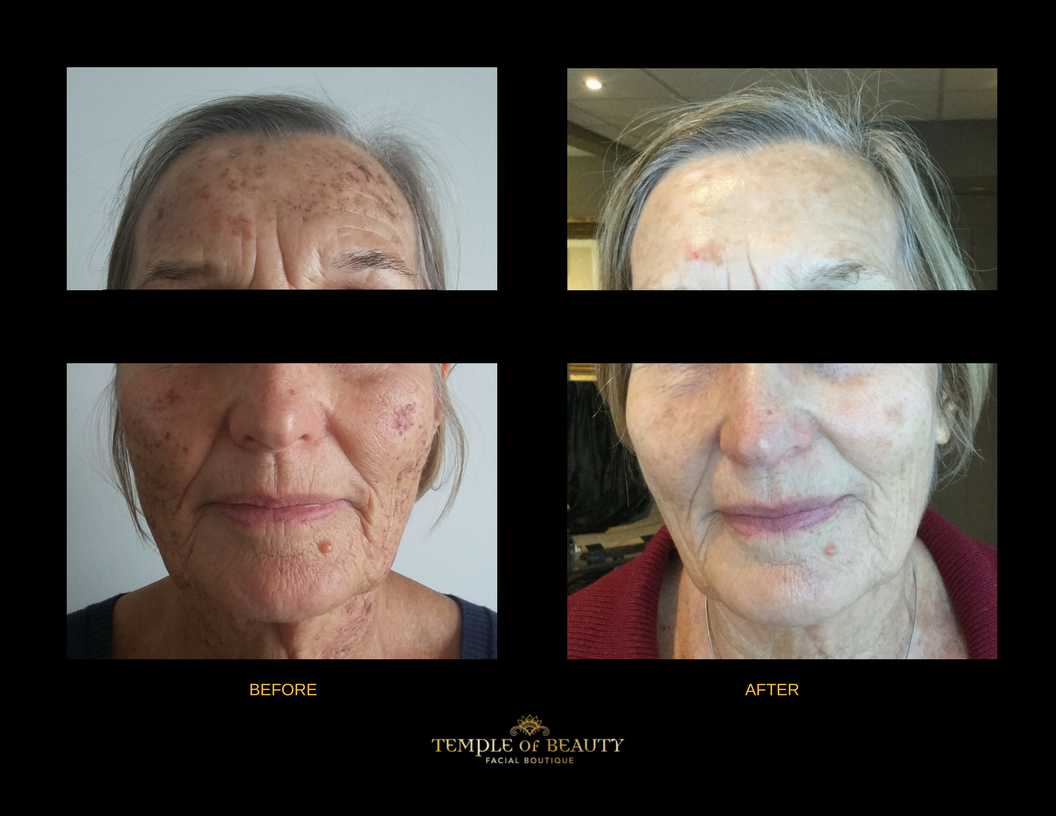 Client Before and After | Skin Rejuvenation