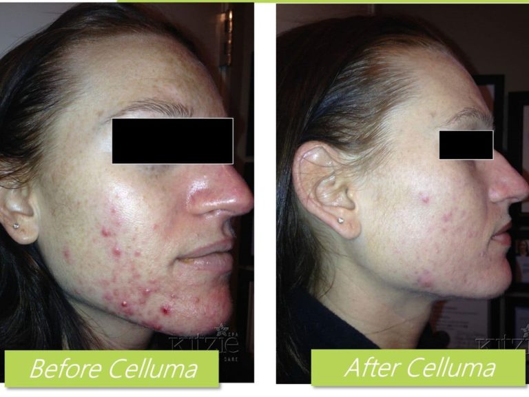 The Formation of Acne Temple of Beauty Facial Boutique